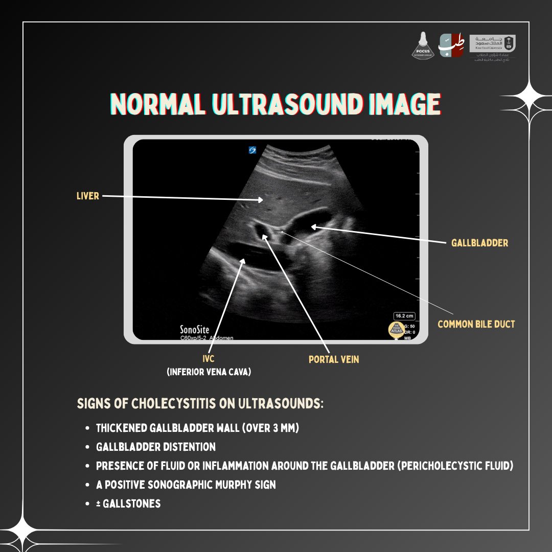 POCUS_IG's tweet image. Tap and learn about gallbladder ultrasound scan ! 
#FOAMD #POCUS #EmergencyMedicine #UltrasoundCase