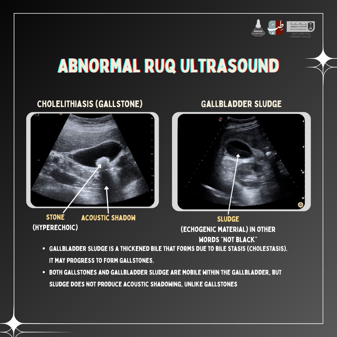 POCUS_IG's tweet image. Tap and learn about gallbladder ultrasound scan ! 
#FOAMD #POCUS #EmergencyMedicine #UltrasoundCase