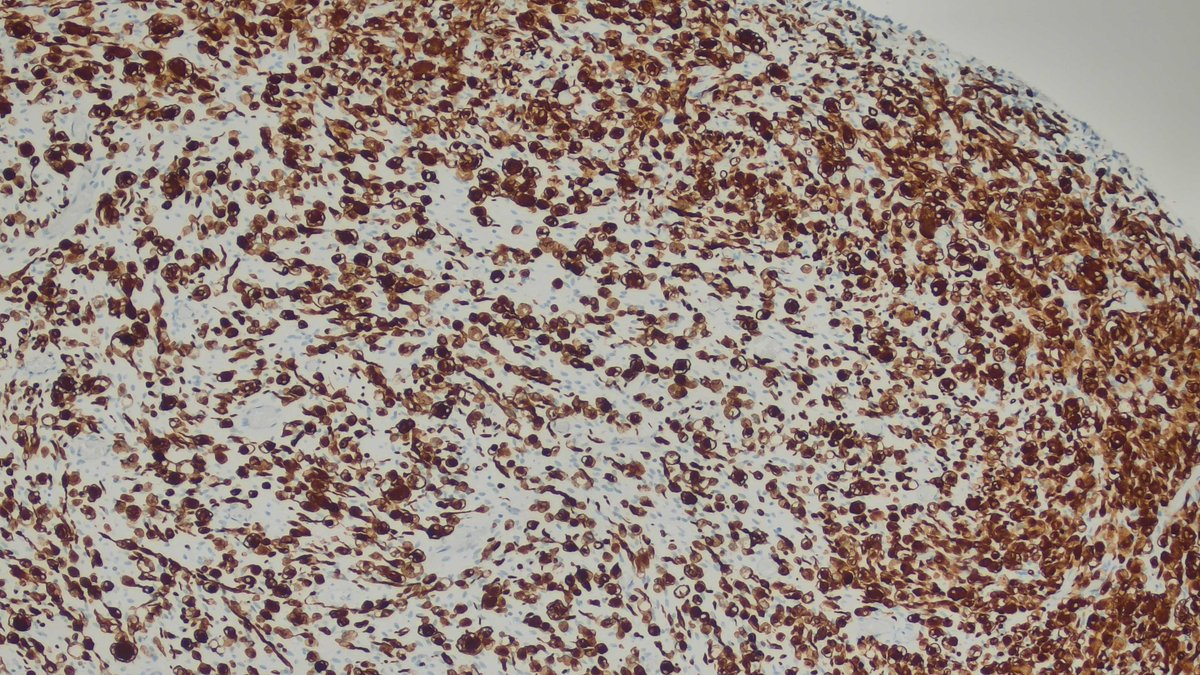 byrk_bsr's tweet image. Case of the day 🔬
2-year-old male with a bladder mass. Tumor cells show diffuse desmin positivity. Findings are consistent with rhabdomyosarcoma...
@IntSocUropath @GU_Path_Society #GUpath #BSTpath