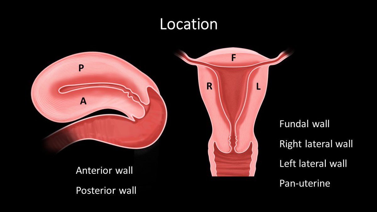 lucianachamiec1's tweet photo. Reporting Adenomyosis? Be sure to include: https://t.co/A0igWs0X4Z