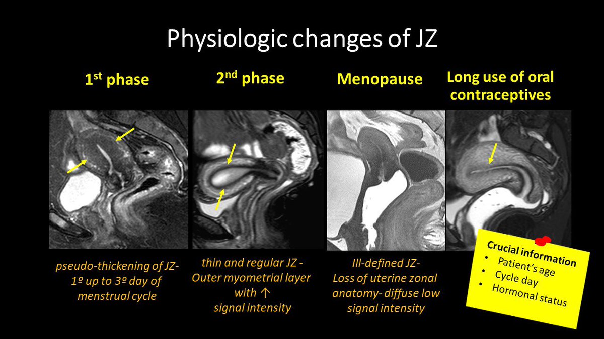 lucianachamiec1's tweet photo. Physiologic changes of the JZ- potential pitfalls of adenomyosis https://t.co/EenyzbwdED