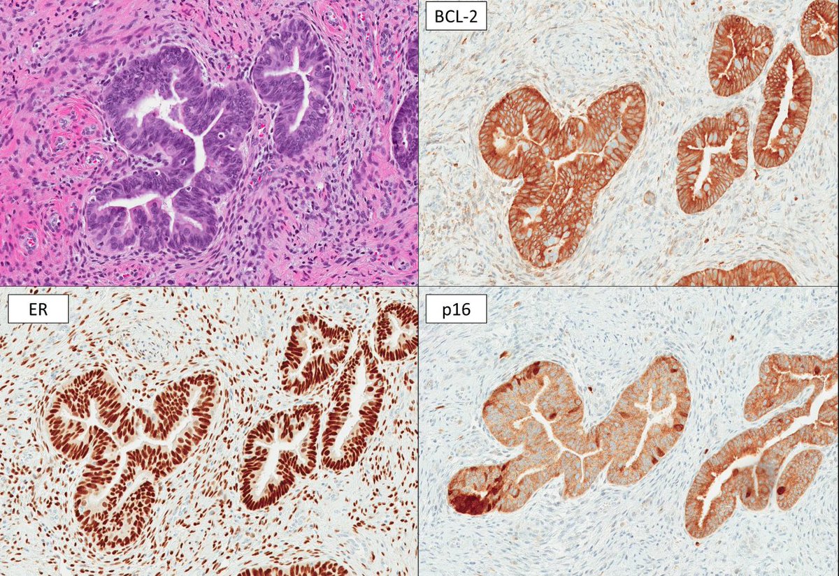 Janiranavarro's tweet image. Uterine cervix - History of adenocarcinoma in situ (AIS) with positive margins → new biopsies come in
Is this AIS?

It’s tuboendometrioid metaplasia.

✅ Seen in ~20% of cone biopsies
✅ Often linked to prior cervical procedures
✅ Columnar mucin-depleted epithelium + reactive