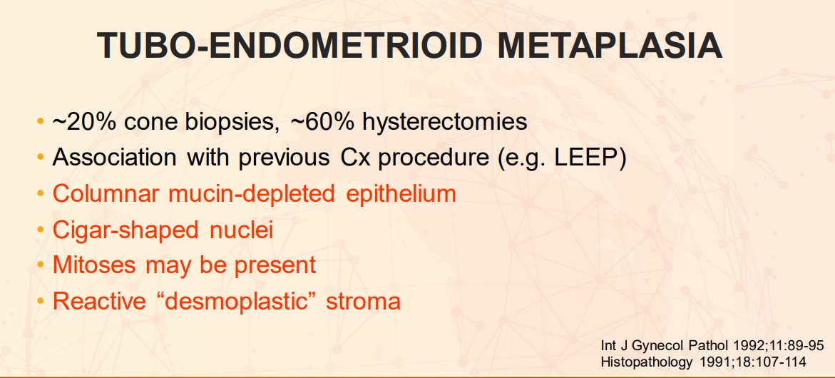 Janiranavarro's tweet image. Uterine cervix - History of adenocarcinoma in situ (AIS) with positive margins → new biopsies come in
Is this AIS?

It’s tuboendometrioid metaplasia.

✅ Seen in ~20% of cone biopsies
✅ Often linked to prior cervical procedures
✅ Columnar mucin-depleted epithelium + reactive