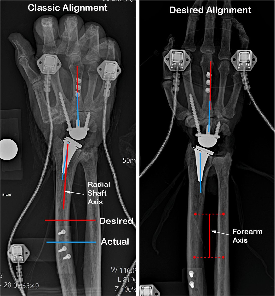 J Hand Surg Am- ASSH tweet media