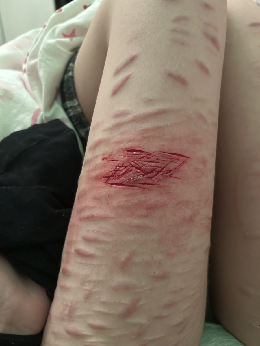 yuukoitoslove's tweet photo. Latest BABY seshes on both my tighs because I was mad lol I was just swiping around so no deep cuts 😭 #shtwt #slittwt #selfharm https://t.co/LYo6w6n7sX