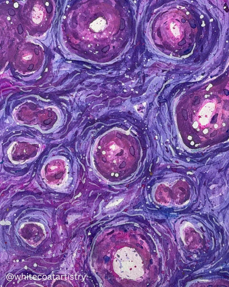 MeredithKHerman's tweet image. #PathArt coincides with @Pathoutlines topic, hot off the press (and the palette) 🎨 
Read about this entity: syringomatous tumor 
👇
pathologyoutlines.com/topic/breastsy…

#PathX
