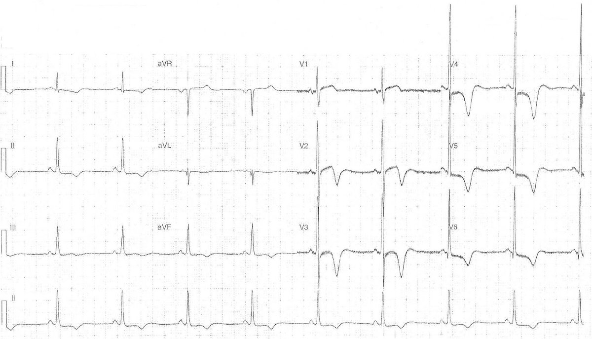 ManualOMedicine's tweet image. This ECG is from a 48-year-old male following an electric shock. The electricity source was a 240V AC domestic supply and the patient sustained a minor burn to his hand.
- What’s your interpretation ?

#medtwitter #foamed #ecg #cardioed
