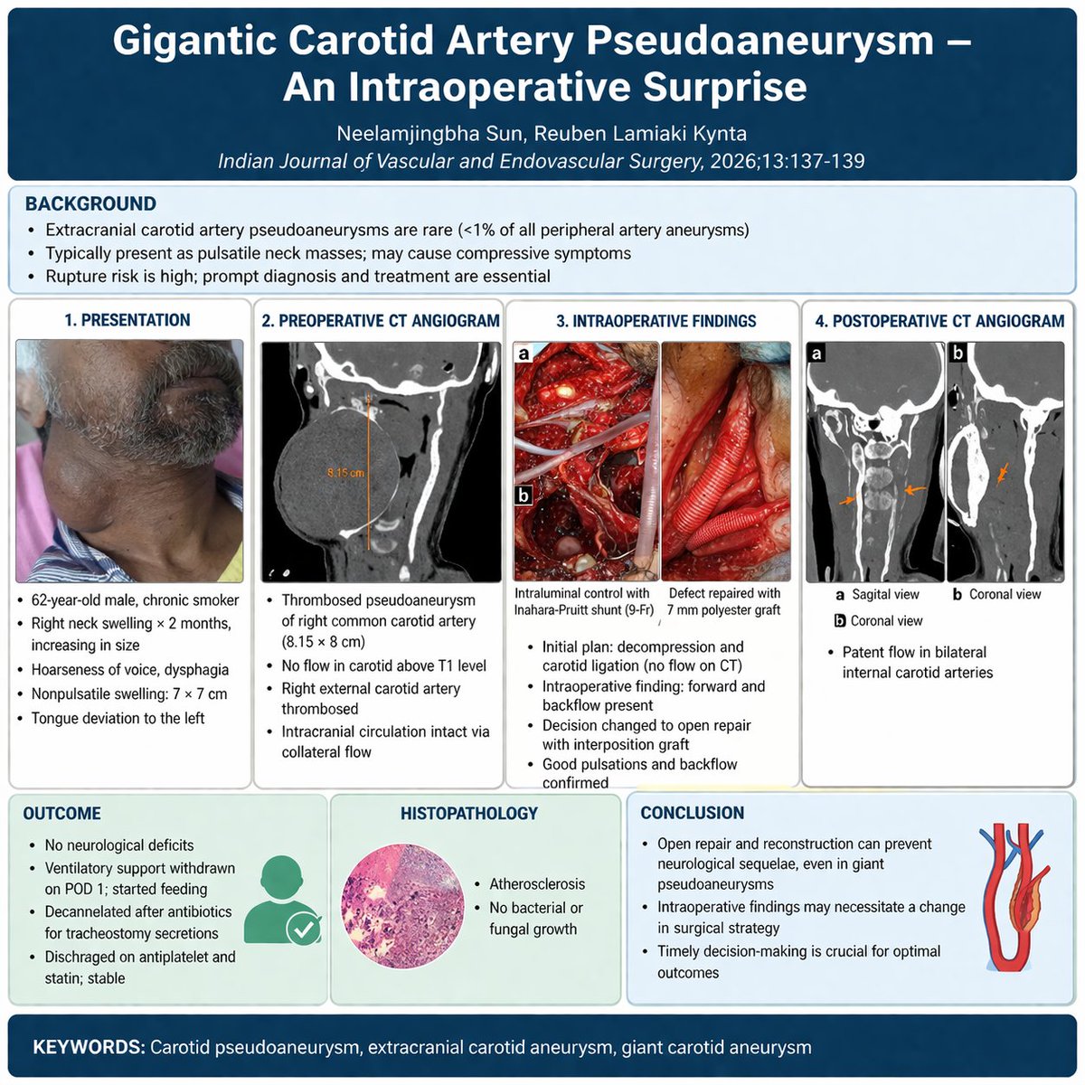 vsijournalijves's tweet photo. Gigantic carotid pseudoaneurysm (~8 cm) with no flow on CT → planned ligation.
Intraop surprise: flow restored after thrombus evacuation → shifted to graft repair.
👉 The best decision is sometimes made on the table
https://t.co/CNn6evLkWY https://t.co/v7cDjl6rHJ
