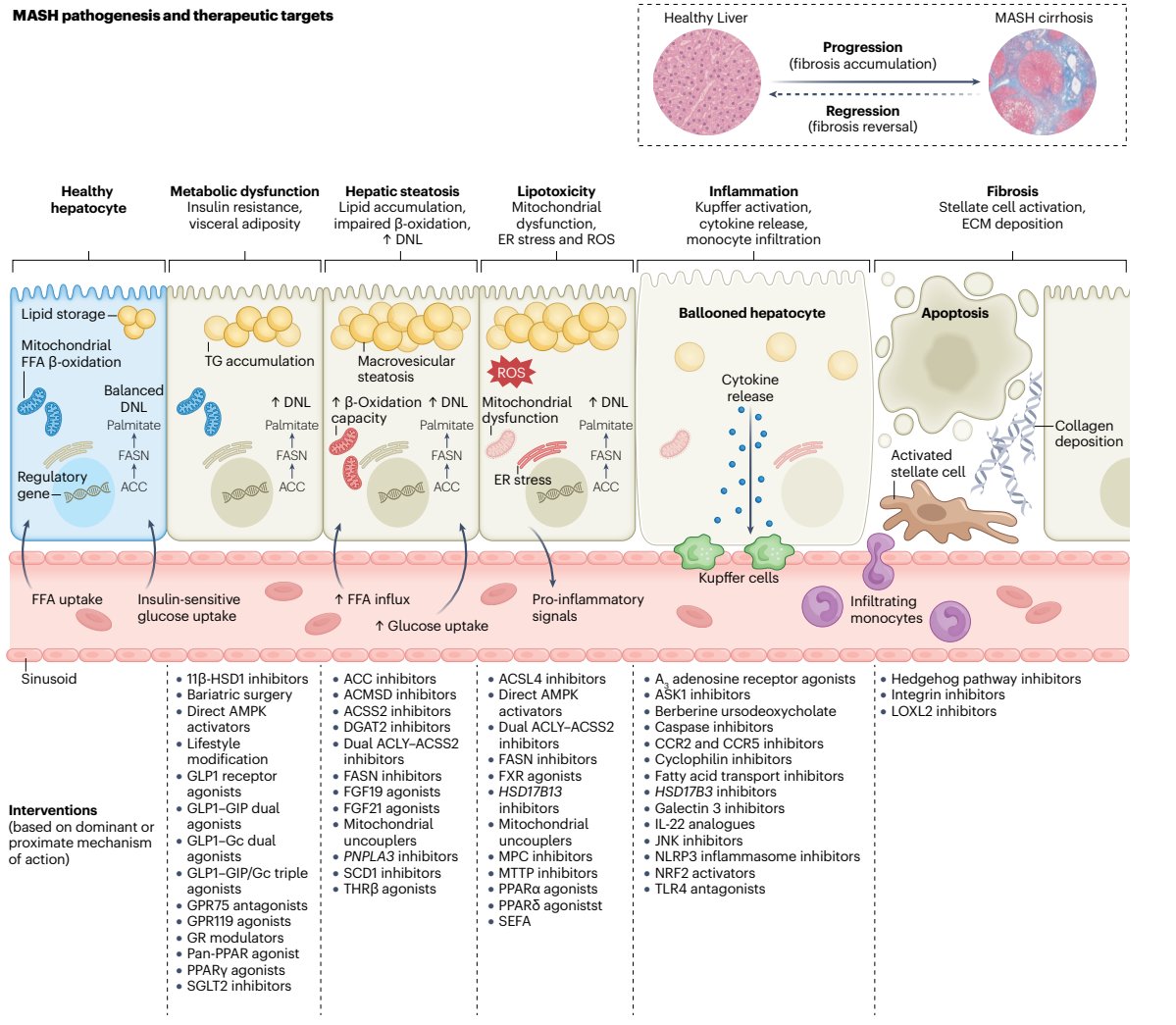scottisaacsmd's tweet photo. Targeting MASH means targeting the whole spectrum, from insulin resistance and steatosis to inflammation, fibrosis and apoptosis. This figure maps pathogenic steps to therapeutic levers, highlighting why combination, mechanism based strategies are the future of #MASH and #MASLD care.
https://t.co/DVMslWicuT