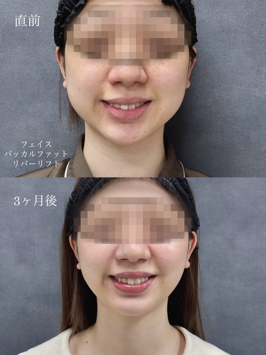 dr__kiya's tweet photo. 【フェイス脂肪吸引＋バッカルファット 除去】
3ヶ月後経過
適応があり適量除去するととても垢抜けます。
笑った時のボリューム感も減少し綺麗な輪郭に。
除去する量、部位が大切なので熟知したドクター選びが大切です。 https://t.co/5xU119px1g