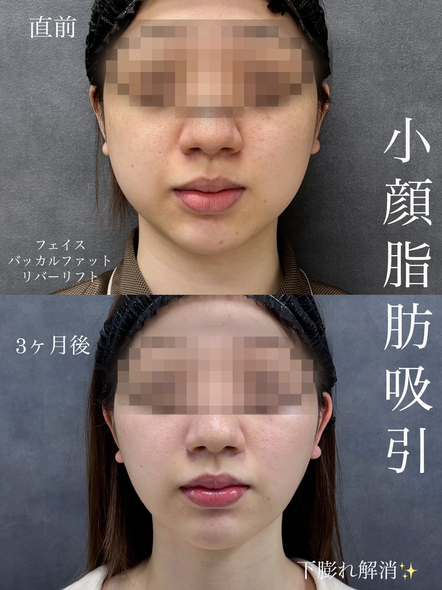 dr__kiya's tweet photo. 【フェイス脂肪吸引＋バッカルファット 除去】
3ヶ月後経過
適応があり適量除去するととても垢抜けます。
笑った時のボリューム感も減少し綺麗な輪郭に。
除去する量、部位が大切なので熟知したドクター選びが大切です。 https://t.co/5xU119px1g