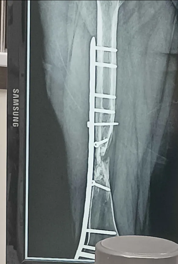 露骨照
膽小慎點...

又過了一年
3年前的今天出的車禍直到現在也依舊沒有痊癒
每隔3個月一次次的追蹤
也越來越心累了
雖然是上個月中拍的照片
但傷勢應該和去年初剛搬家的情況差不多
9月再搬新家再開一次刀也只是照片裡骨頭陰影慢慢的白化長比較結實而已
海兔這樣拄著拐杖的日子什麼時候才到頭呢...