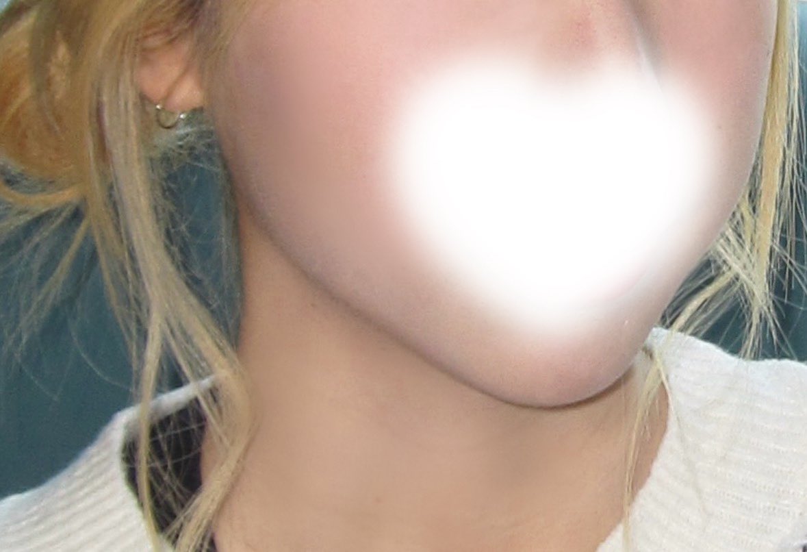 무턱에서… 얼굴형 예뻐지는 법 알려드림 🥹

어렸을 때부터 무턱, 투턱, 비대칭 때문에 외모정병 걸리고 교정이랑 양악까지 생각했는데 ,, 1년~ 1년 반만에 이렇게 됨 😭

성형❌ 시술❌ 보정❌에 돈 거의 안 들어감 💸
광고 당연히 아님 👍🏻

타래로 ➿