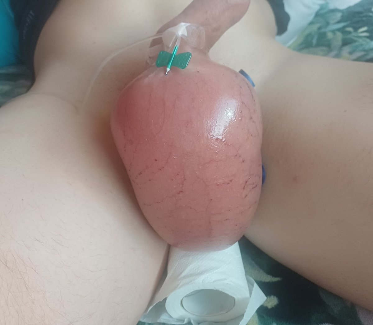 Franco92418723's tweet photo. Long awaited infusion amazing to be this big. https://t.co/f9wJVlgTC7