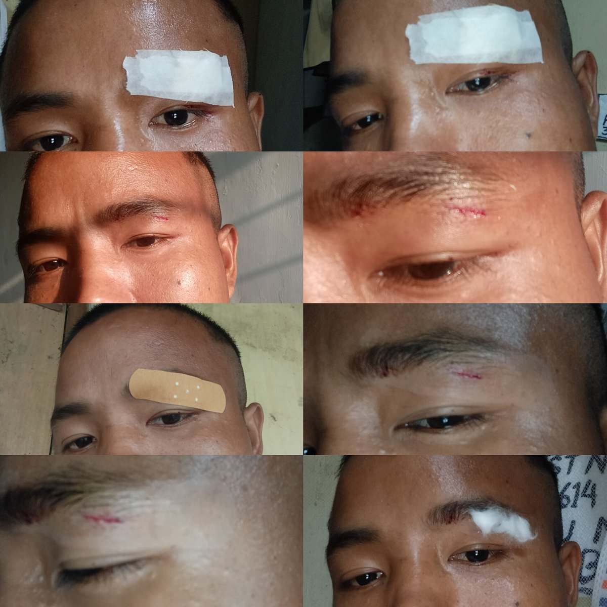 NarahPintu's tweet photo. during football match slightly injured by hit elbow, now almost recovered https://t.co/k1jZdlAI6d