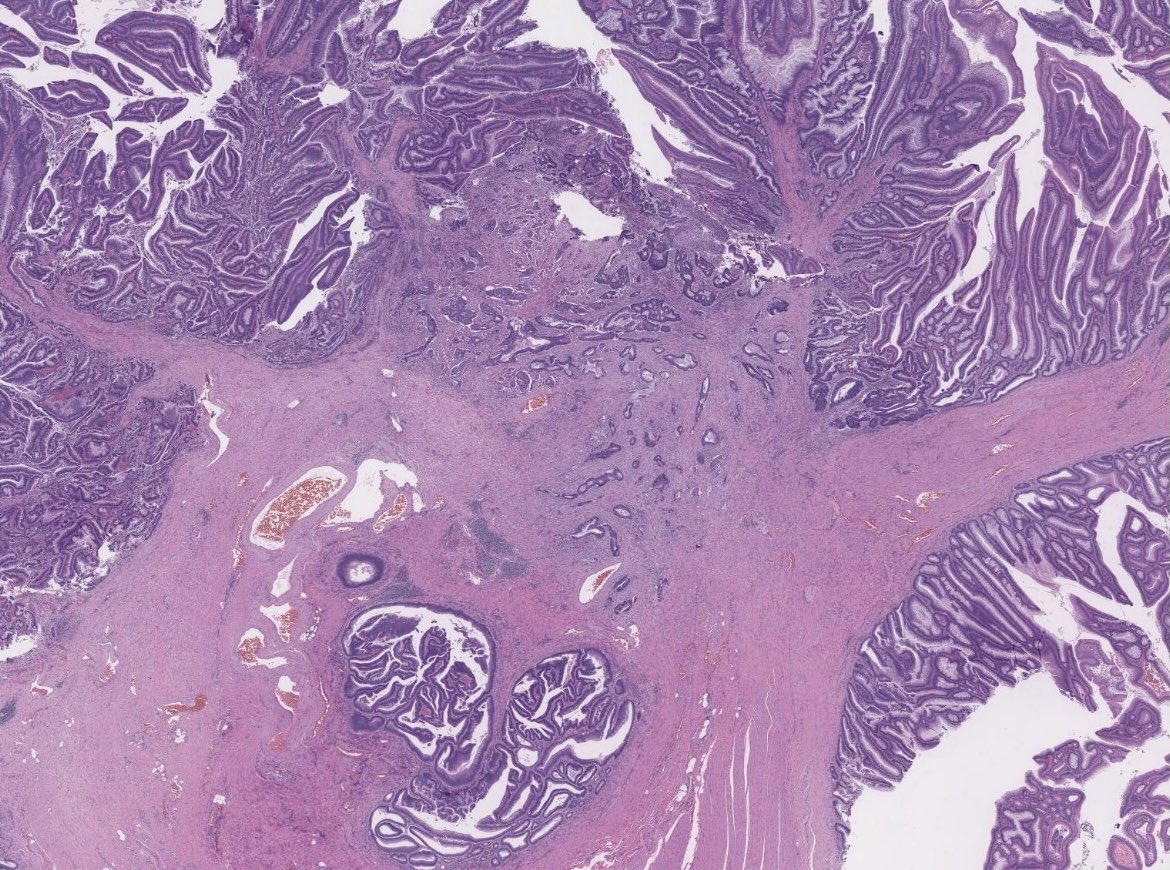 BrownPathology's tweet image. #Pathresidents #GIPath #Surgpath 

A resection from a 2cm pedunculated polyp found on screening colonoscopy in a 60 year old man:

See the thread for a poll, and some short discussion slides.