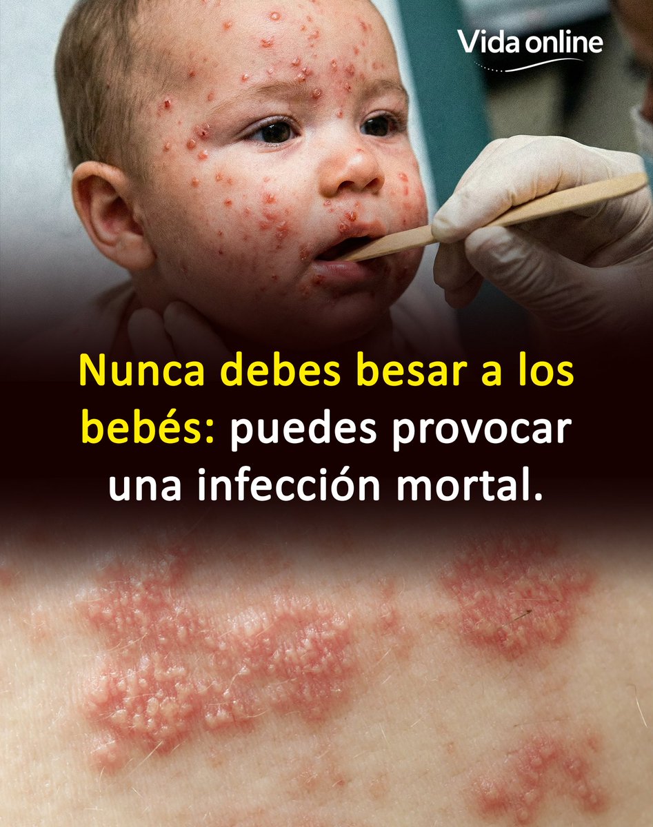 Bio_comunidad's tweet photo. Besar a un bebé suele verse como un gesto inocente, pero desde la medicina puede convertirse en un riesgo evitable.

Muchos adultos portan herpes labial sin lesiones visibles y pueden transmitir el virus a través de la saliva sin notarlo.

En un recién nacido, cuyo sistema inmune es inmaduro, ese virus puede diseminarse rápidamente por todo el organismo.

El herpes simple tiene afinidad por el tejido nervioso y puede alcanzar el cerebro, causando encefalitis grave.

También puede afectar hígado y pulmones, provocando un deterioro clínico acelerado en cuestión de horas o pocos días.

Sin tratamiento antiviral inmediato, el riesgo de muerte aumenta, y los sobrevivientes pueden quedar con secuelas neurológicas permanentes. 👇 🧵