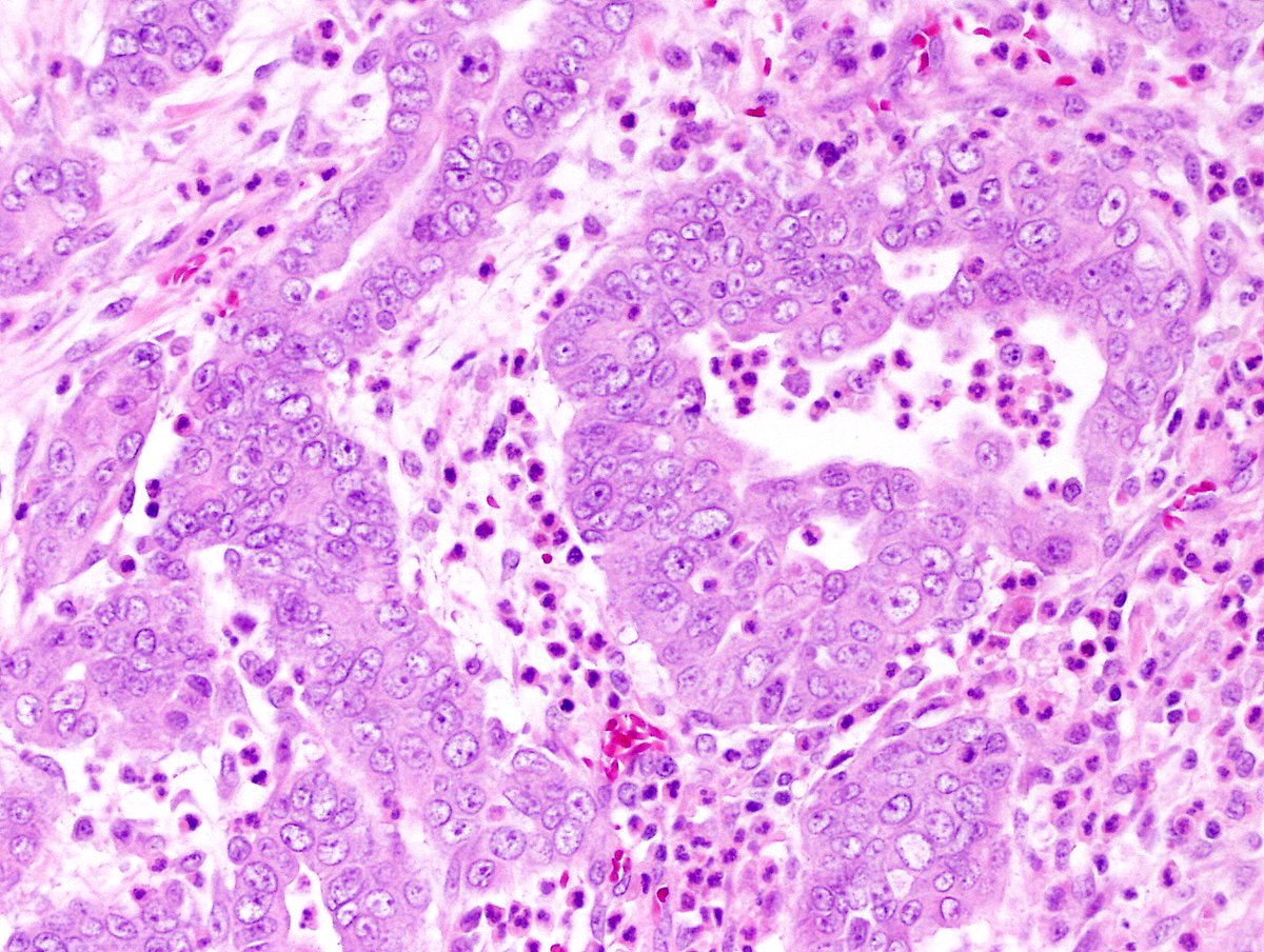Andres_Matoso's tweet image. Renal Medullary Carcinoma (RMC): highly aggressive tumor in patients with sickle cell trait.
🔬 Infiltrative growth with tubuloreticular and gland-like structures. Pleomorphic nuclei w/ prominent nucleoli. Brisk inflam infiltrate. Associated w/ necrosis and loss of SMARCB1/INI1