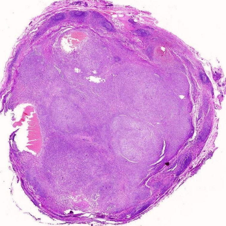 #PathQuiz 🔬
A 16-year-old female presents with a slow-growing, painless mass in the antecubital fossa.

A) Pleomorphic hyalinizing angiectatic tumor
B) Hemosiderotic fibrolipomatous tumor
C) Deep (aggressive) angiomyxoma
D) Angiomatoid fibrous histiocytoma

#Pathology