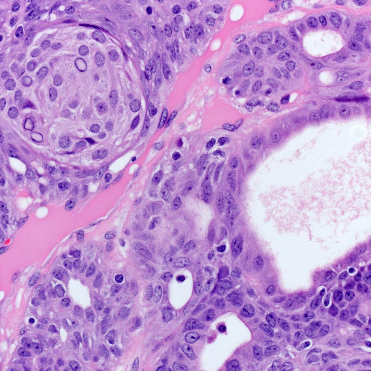 DrCycloPath's tweet photo. #PathQuiz 🔬🦋 #EndoPath

A) Secretory carcinoma
B) Hyalinizing trabecular tumor
C) Papillary thyroid carcinoma
D) Cribriform morular thyroid carcinoma

#Pathology #ThyroidPath Clue in caption 🧐 https://t.co/m4N1XbzwTE