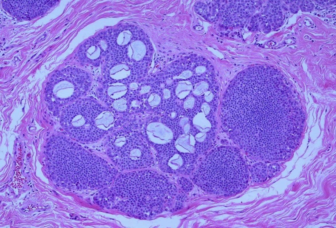BrownPathology's tweet image. #Pathresidents #Surgpath #breastpath #pathology 

An incidental finding in a reduction mammoplasty in a 50 year old woman with no significant history.  

Read on for a poll and a quick discussion.