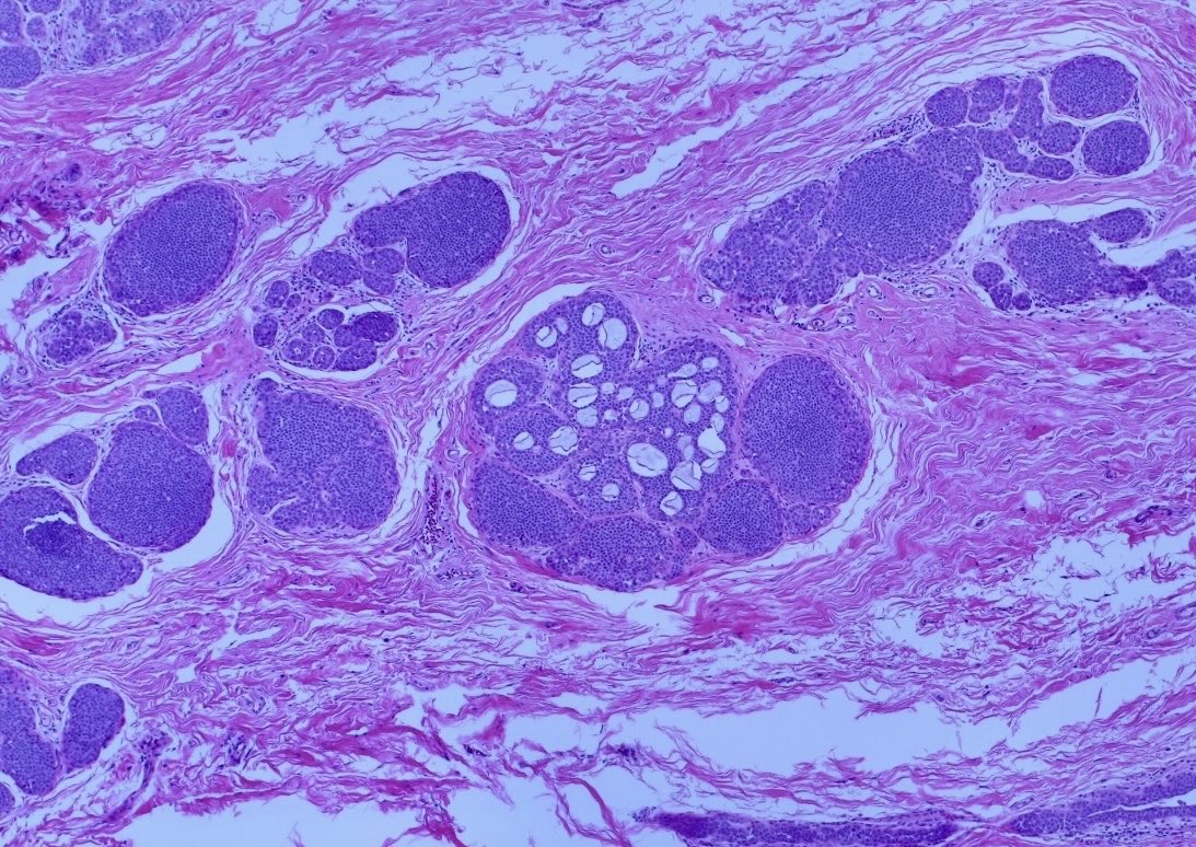 BrownPathology's tweet image. #Pathresidents #Surgpath #breastpath #pathology 

An incidental finding in a reduction mammoplasty in a 50 year old woman with no significant history.  

Read on for a poll and a quick discussion.