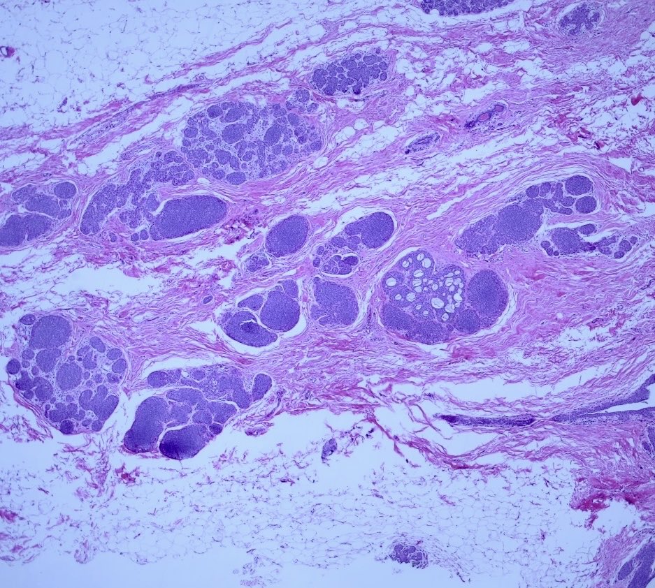 BrownPathology's tweet image. #Pathresidents #Surgpath #breastpath #pathology 

An incidental finding in a reduction mammoplasty in a 50 year old woman with no significant history.  

Read on for a poll and a quick discussion.