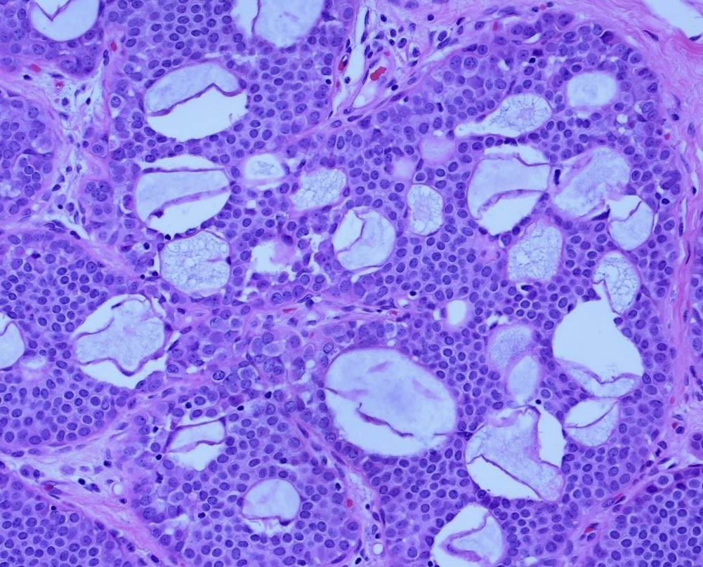 BrownPathology's tweet image. #Pathresidents #Surgpath #breastpath #pathology 

An incidental finding in a reduction mammoplasty in a 50 year old woman with no significant history.  

Read on for a poll and a quick discussion.