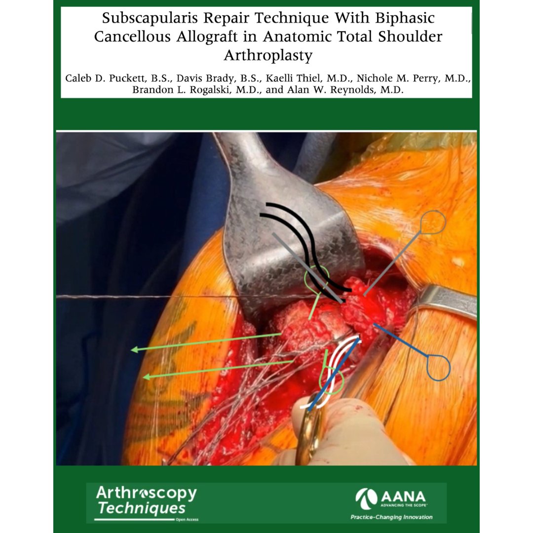 ArthroscopyJ's tweet image. Check out this innovative subscapularis repair technique utilizing cancellous allograft for use in anatomic shoulder arthroplasty. #TSA #shoulderarthroplasty #arthroscopy