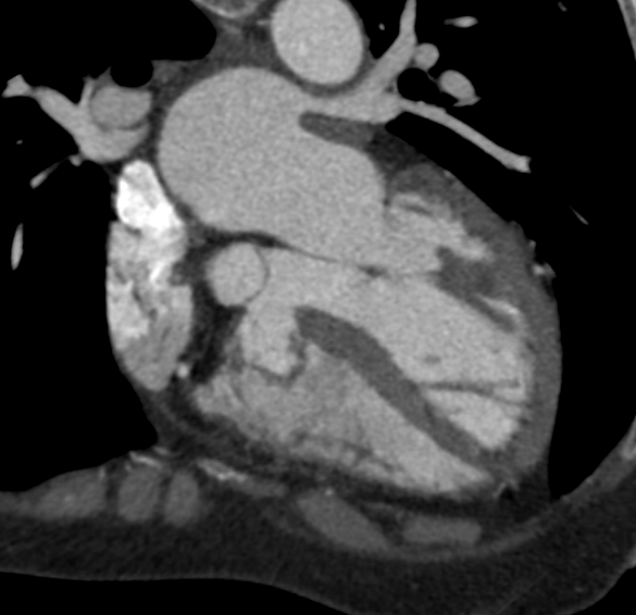 MaddiWulfeckMD's tweet image. Cardiac CT time 🫀🕐

There’s… something happening along the interventricular septum.

What are we looking at here?? 👀

#Radiology #CT #Radres #Medtwitter