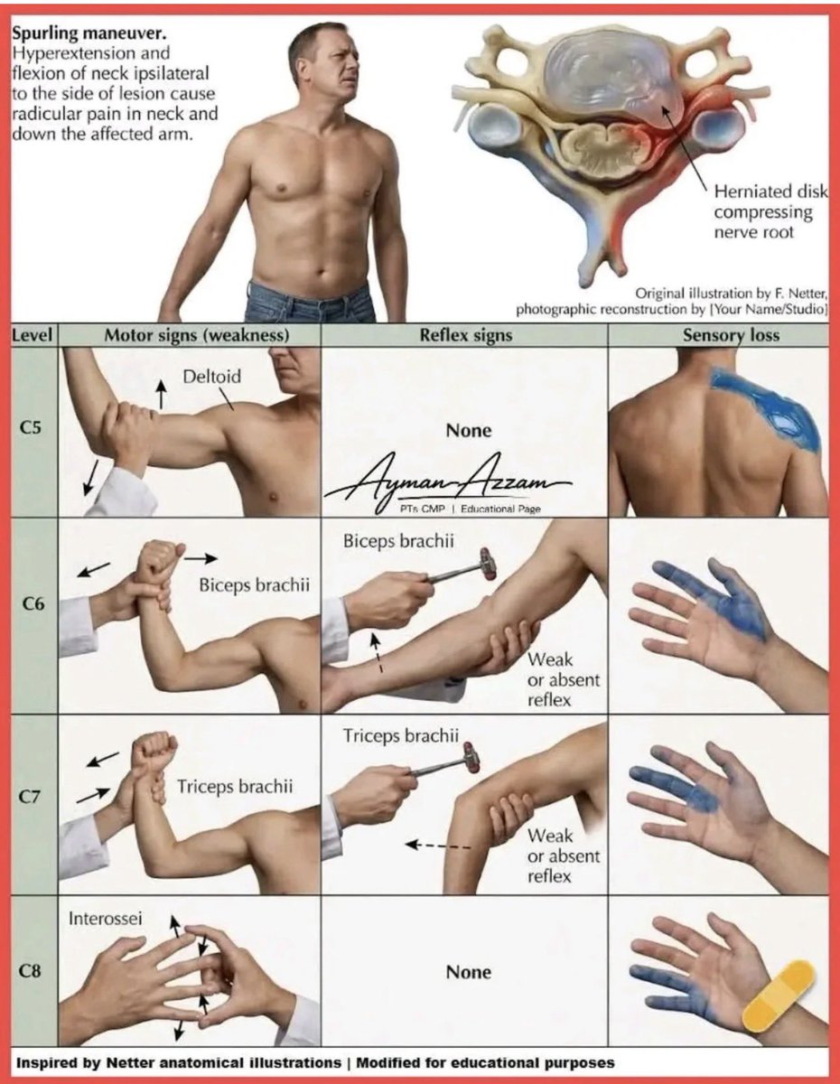 OGdukeneurosurg's tweet photo. Cervical disc exam by netter and azzam https://t.co/b9F01xHoK1