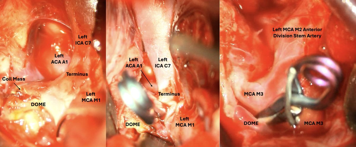 ScullenTyler's tweet photo. Endovascular management of cerebral aneurysms is increasingly, but not always, the answer, and proficiency in all techniques remains critical for aspiring contemporary cerebrovascular surgeons, as shown in these left recurrent terminus and distal MCA aneurysms treated by clip ligation in the same craniotomy. #aneurysm #neurosurgery #cerebrovascular