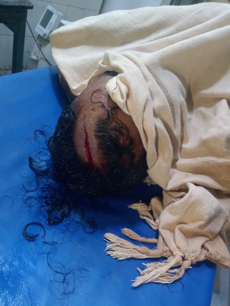 प्रतापगढ़ के कोहंडौर थाना में 20.02.26 को पंकज यादव पर लोहे की रॉड, कुल्हाड़ी, फरसा से जानलेवा हमला किया गया।सिर में 14 टांके लगे है और लकवे जैसी स्थिति बन गई है।धारा 109 BNS बढ़ाकर तत्काल गिरफ्तारी व निष्पक्ष जांच सुनिश्चित करें।
<a href="/Uppolice/">UP POLICE</a>
<a href="/pratapgarhpol/">PRATAPGARH POLICE</a>
<a href="/myogiadityanath/">Yogi Adityanath</a>