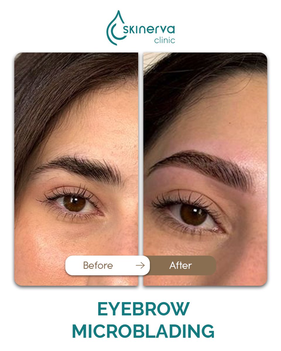 skinervaclinic's tweet image. The difference a little precision makes.

Book your consultation at Skinerva Clinic.

#SkinervaClinic #Microblading #EyebrowMicroblading #BrowsOnPoint #SemiPermanentMakeup