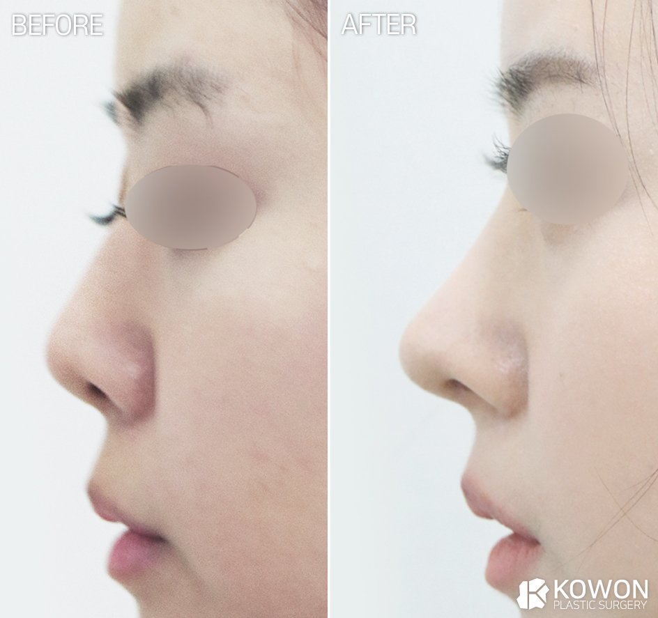 Dr.KimHT (コウォン整形外科) tweet media