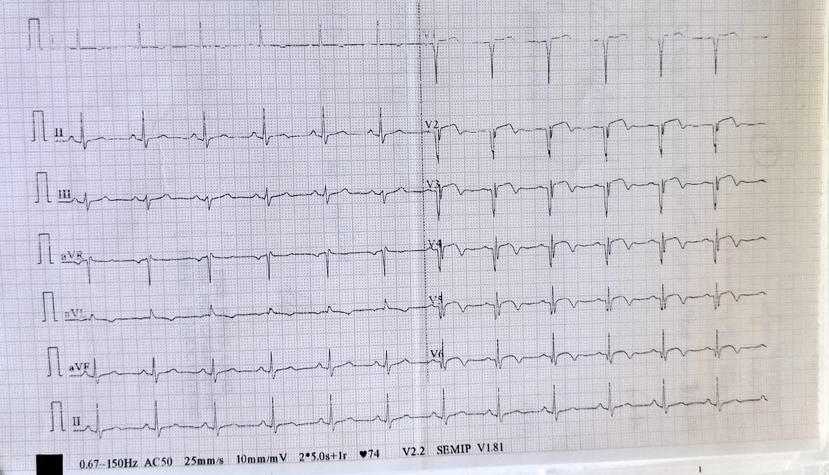 Dr_Shiv_kumar_'s tweet image. 🚨 🫀 ECG case alert 

An 82-year-old male with central chest pain + SOB.
History of Hypertension and Type 2 Diabetes Mellitus, non-compliant &amp;amp; no previous H/O IHD. 

Diagnosis?
Culprit artery?
Key ECG changes?

#MedX #ECG