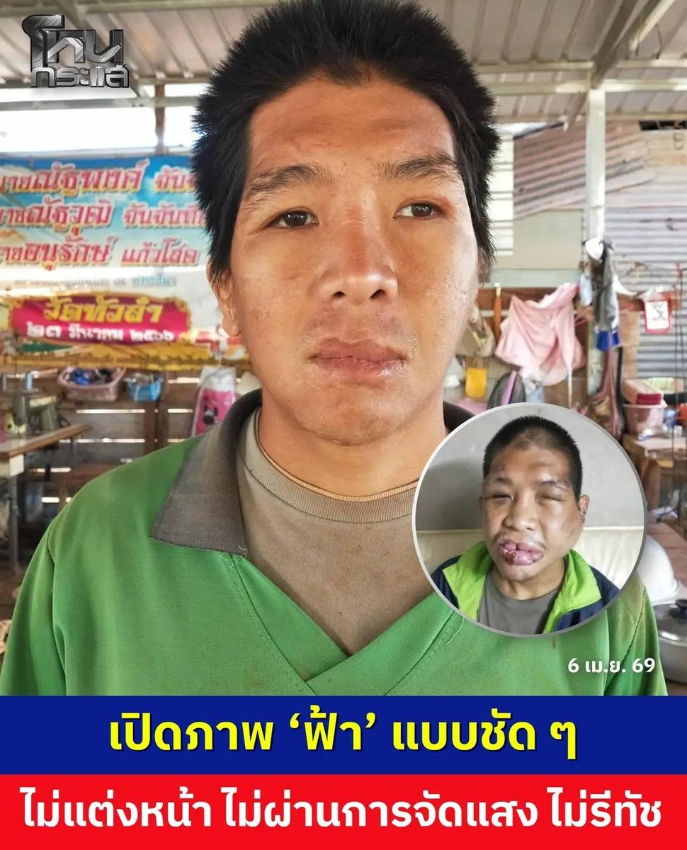 มึง นี่คือใบหน้า ที่แท้จริงของน้องฟ้า หลังจากที่ทำ ศัลยกรรมมายาวนานกว่า 4 ปี ทุกวันนี้ คนก่อเหตุยังอยู่ในคุก ไม่ยอมรับผิดชอบค่าเสียหาย ขอให้น้องได้รับความเป็นธรรมด้วยนะครับ !!!!

#โหนกระแส