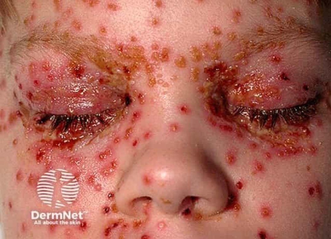 IhabFathiSulima's tweet image. What is the diagnosis?