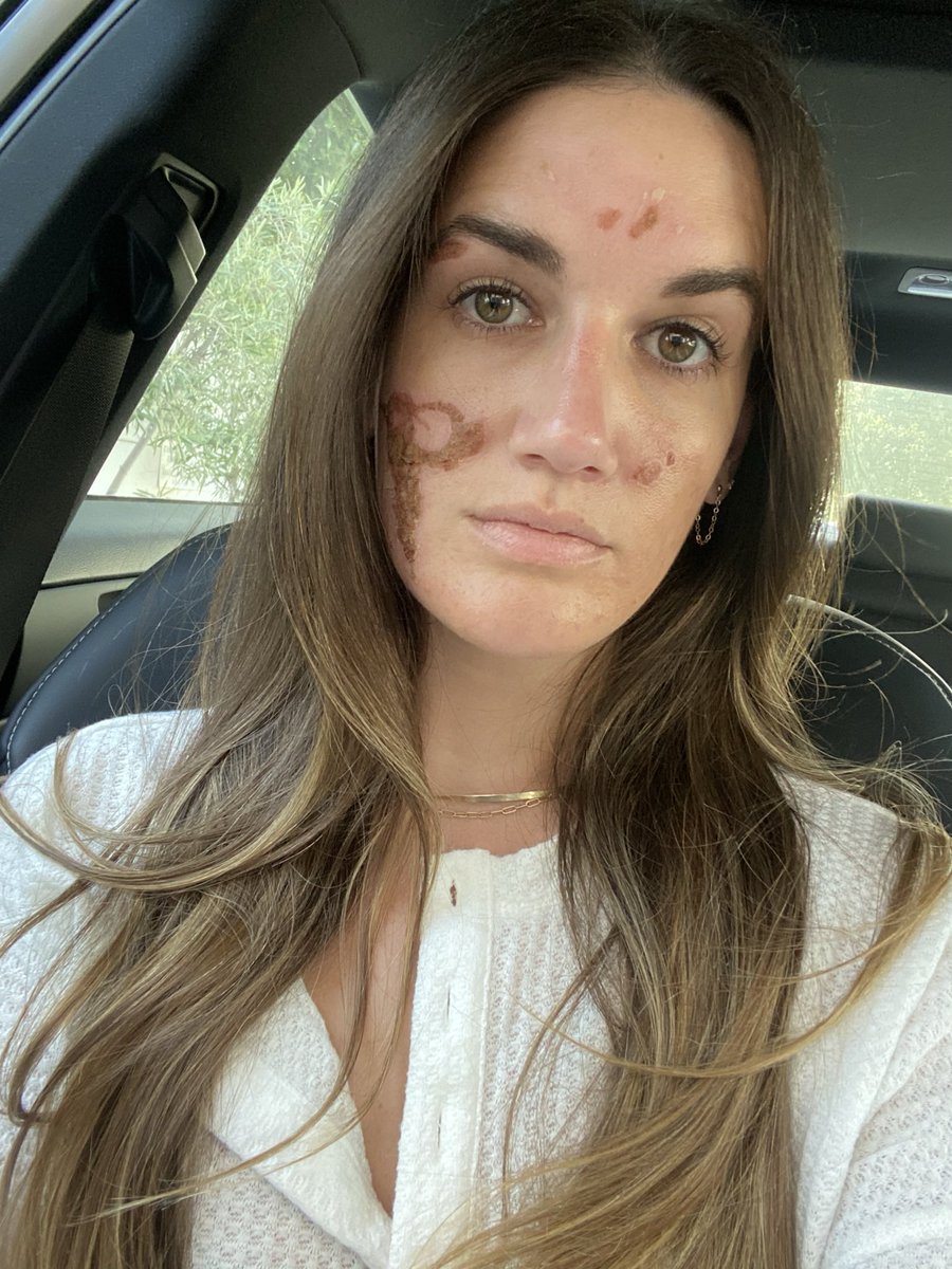 victoriannelson's tweet photo. 5 years ago, my face was permanently scarred by Sonya Dakar. 

And for 5 years, I’ve been the one living with the consequences of her actions. https://t.co/0pnhLR1l9B