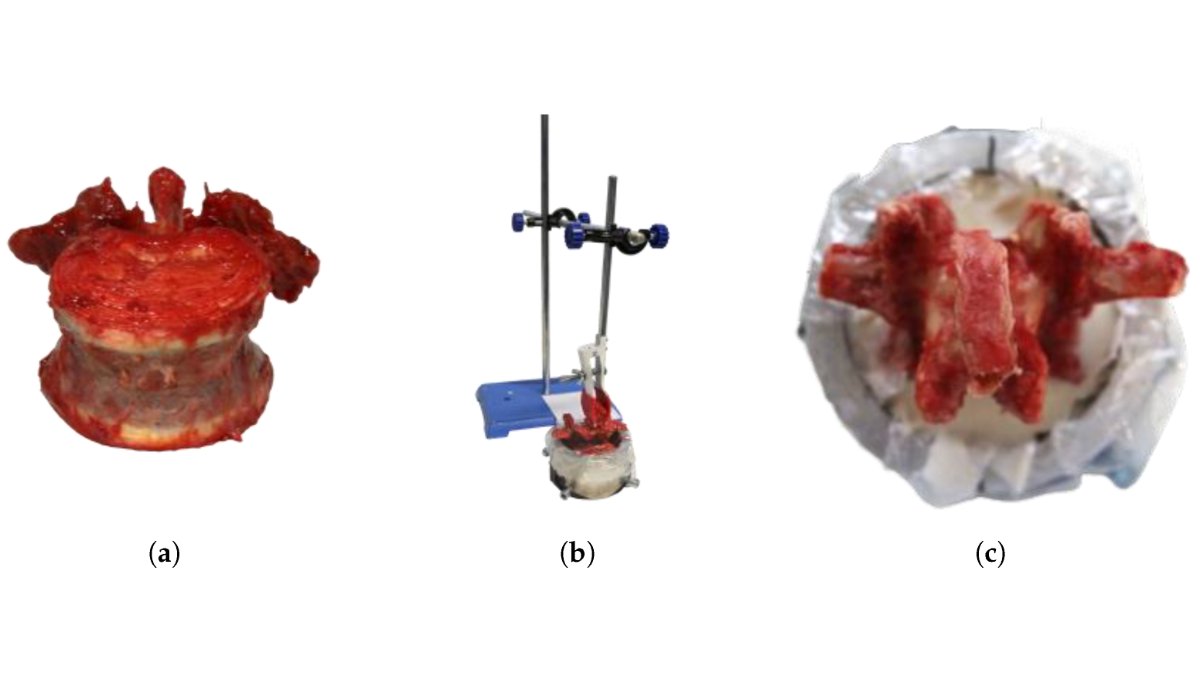 Bioeng_MDPI's tweet image. 💥Check out our Editor's Choice publication: "Does Resistance Indicate Malposition? A Standardized Comparison of Pedicle Screw Placement"
🔗 brnw.ch/21x1meQ
📌 #biomechanics #spine #experiment #pediclescrew #mechanicalresistance #screwmisplacement #malposition #torque