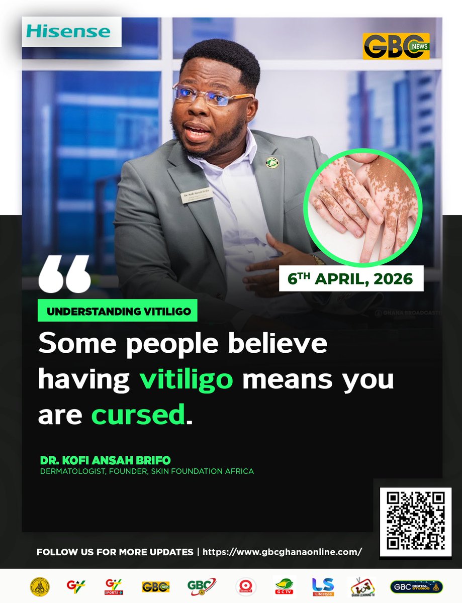GTV_Ghana's tweet image. Having vitiligo does not mean you are cursed

-Dr. Kofi Ansah Brifo, Dermatologist, Founder, Skin Foundation Africa

#gbcnews
#skincare
#BreakfastShow