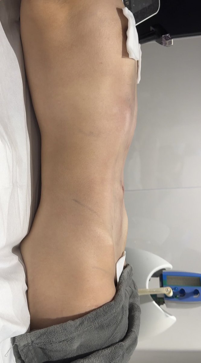 『クルスカで太ります』

リンダ・エヴァンジェリスタが苦しんだ、
クルスカの合併症“逆説的過形成”

今日オペした方も同じく、クルスカ後に脂肪が増えて辛い思いをされた方でした。

直後のビフォアフはこんな感じ。
長期経過も追っていきます。
（姿勢詐欺は許してください）