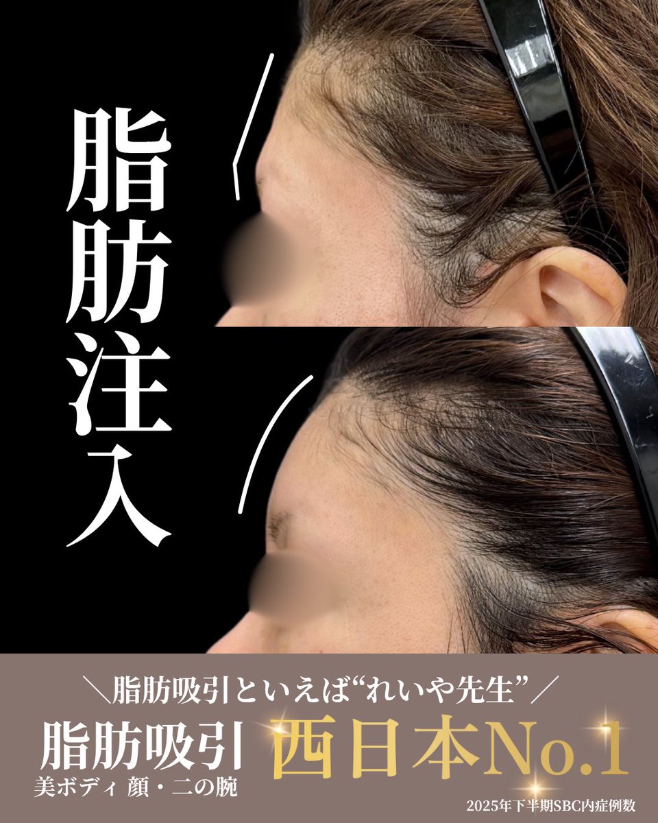 dr_reiya's tweet photo. ◎額・こめかみ脂肪注入
術前⇒術後1ヶ月の経過

額・こめかみは加齢とともに痩せ、コケが目立つようになります😱
ゴツゴツした額は老けて見えやすく、男性的な印象を与えます。
そのため、つや・ハリのある丸い額をつくることで若々しく、女性らしい印象の輪郭になります✨

また、自身の脂肪を注入するため、安全性も高く、定着した脂肪は半永久的な効果が期待できます👏

🏆脂肪吸引(美ボディ/全部位総合)症例数西日本1位 全国2位 2025年下期SBC内

神戸三宮で全国有数の症例数、技術力
脂肪吸引は、れいや先生にお任せください👨‍⚕️

ご予約はプロフィールのリンクから👈
皆様のご来院お待ちしております✨

✴︎2025年下半期SBC内 症例数✴︎
◉脂肪吸引（美ボディ/全部位総合）
 西日本1位🥇 全国2位🥈
◉脂肪吸引注射 関西2位🥈
◉脂肪注入(ナチュラル脂肪注射) 関西2位🥈
◉糸リフト 関西3位🥉
◉バッカルファット除去 関西3位🥉
………………………………………………
🏥イテウォンビューティークリニック神戸院
📍 兵庫県神戸市中央区御幸通6-1-10
オリックス神戸三宮ビル 5階
🏃‍♂️JR三ノ宮駅徒歩5分
⏰ 9:00〜18:00▶︎不定休
☎️0120-832-900
………………………………………………

施術名：ナチュラル脂肪注射（脂肪注入）
施術の説明：麻酔液や水分を分離したご自身の脂肪を注入して肌にハリを持たせ、しわを改善する治療です。
施術の副作用（リスク）：だるさ・熱感・頭痛・蕁麻疹・痒み・むくみ・発熱・咳・冷や汗・胸痛・吸引部の皮膚が硬くなる、凹凸になる・施術箇所の知覚の麻痺・鈍さ、しびれ・皮膚の色素沈着などを生じることがあります。
施術の価格：43,300円～118,400円
平均的な治療回数：1回
ダウンタイム期間：1～2週間（個人差あり）

#湘南美容クリニック 
#脂肪注入