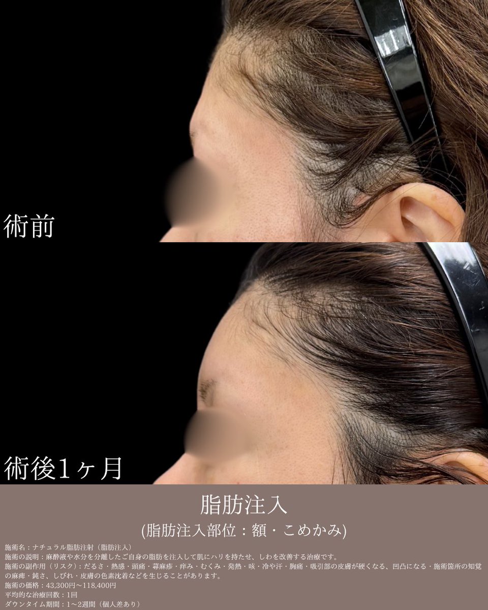 dr_reiya's tweet photo. ◎額・こめかみ脂肪注入
術前⇒術後1ヶ月の経過

額・こめかみは加齢とともに痩せ、コケが目立つようになります😱
ゴツゴツした額は老けて見えやすく、男性的な印象を与えます。
そのため、つや・ハリのある丸い額をつくることで若々しく、女性らしい印象の輪郭になります✨

また、自身の脂肪を注入するため、安全性も高く、定着した脂肪は半永久的な効果が期待できます👏

🏆脂肪吸引(美ボディ/全部位総合)症例数西日本1位 全国2位 2025年下期SBC内

神戸三宮で全国有数の症例数、技術力
脂肪吸引は、れいや先生にお任せください👨‍⚕️

ご予約はプロフィールのリンクから👈
皆様のご来院お待ちしております✨

✴︎2025年下半期SBC内 症例数✴︎
◉脂肪吸引（美ボディ/全部位総合）
 西日本1位🥇 全国2位🥈
◉脂肪吸引注射 関西2位🥈
◉脂肪注入(ナチュラル脂肪注射) 関西2位🥈
◉糸リフト 関西3位🥉
◉バッカルファット除去 関西3位🥉
………………………………………………
🏥イテウォンビューティークリニック神戸院
📍 兵庫県神戸市中央区御幸通6-1-10
オリックス神戸三宮ビル 5階
🏃‍♂️JR三ノ宮駅徒歩5分
⏰ 9:00〜18:00▶︎不定休
☎️0120-832-900
………………………………………………

施術名：ナチュラル脂肪注射（脂肪注入）
施術の説明：麻酔液や水分を分離したご自身の脂肪を注入して肌にハリを持たせ、しわを改善する治療です。
施術の副作用（リスク）：だるさ・熱感・頭痛・蕁麻疹・痒み・むくみ・発熱・咳・冷や汗・胸痛・吸引部の皮膚が硬くなる、凹凸になる・施術箇所の知覚の麻痺・鈍さ、しびれ・皮膚の色素沈着などを生じることがあります。
施術の価格：43,300円～118,400円
平均的な治療回数：1回
ダウンタイム期間：1～2週間（個人差あり）

#湘南美容クリニック 
#脂肪注入