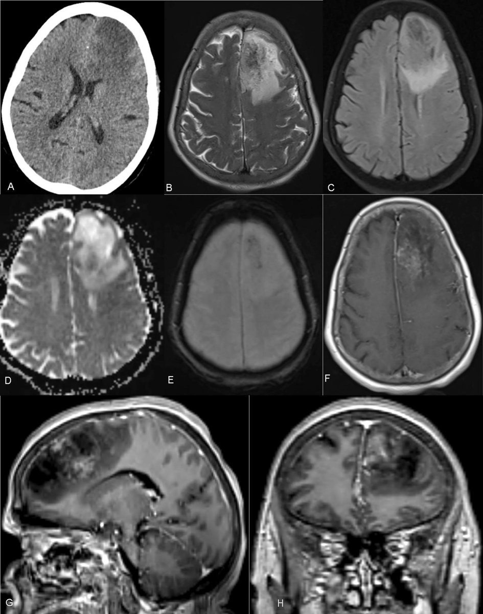 _jocn's tweet photo. Cerebral rheumatoid vasculitis masquerading as an intracranial neoplasm — a great reminder to keep autoimmune etiologies on the differential for atypical brain lesions. When imaging is inconclusive, biopsy is essential. Early immunosuppression can change outcomes.

🔗 https://t.co/hUPvvs9stw

#NeuroTwitter #NeurocriticalCare #Neuroimaging #Stroke #Rheumatology #CNSVasculitis #MedEd #AcademicMedicine #JCN
