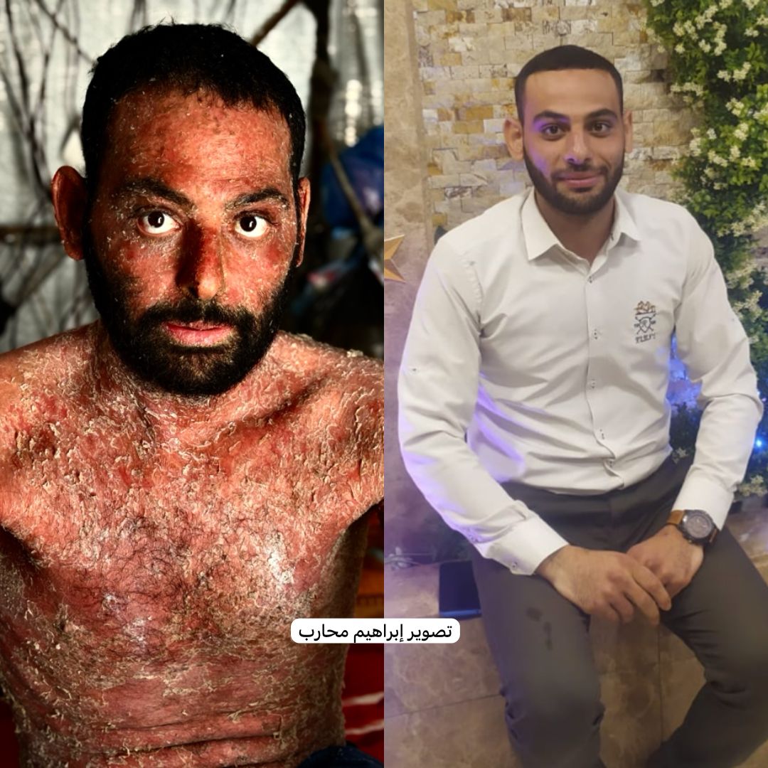 لا حول ولا قوة إلا بالله…
الشاب إبراهيم أبو عرام انتقل إلى رحمة الله، بعد معاناة طويلة مع مرض الفقاع الشائع، حيث ناشد العالم كثيرًا مطالبًا بحقه في العلاج، لكن صرخاته لم تجد استجابة، بعد ان تم منعه من السفر للعلاج بالخارج.