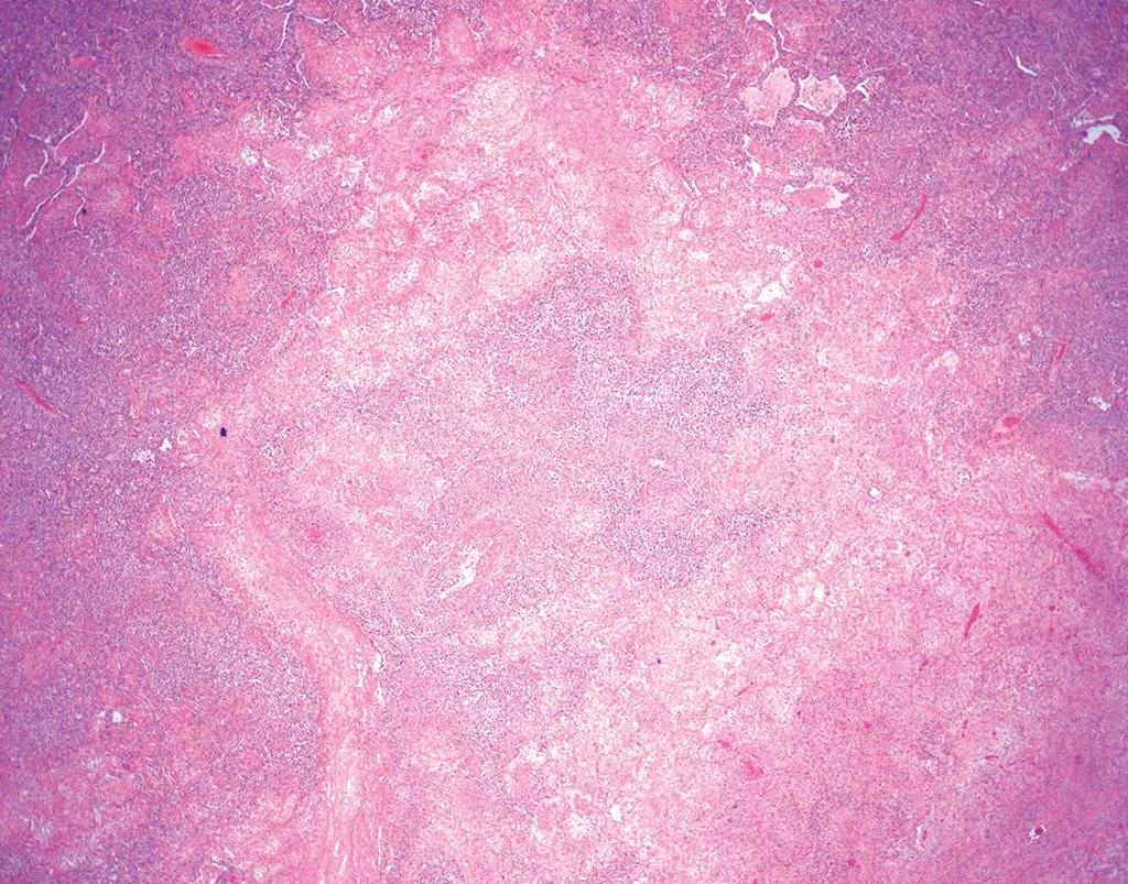 DrCycloPath's tweet photo. ✅ Lymphomatoid Granulomatosis 🎯🫁
• Angiodestructive polymorphous infiltrate with geographic necrosis
• Driven by EBV-infected B cells in a background of reactive T cells
• Graded (1-3) based on the absolute density of large atypical cells
• Despite the name, well-formed granulomas are characteristically absent