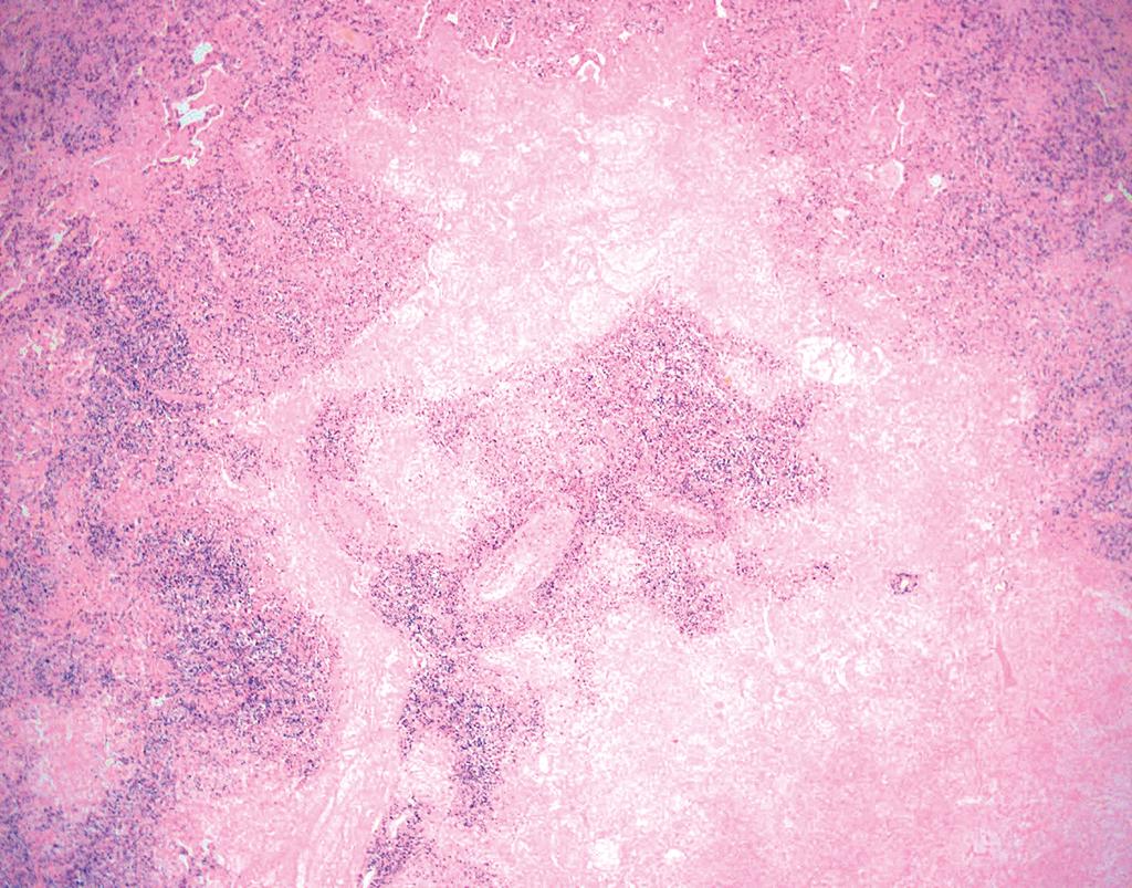 DrCycloPath's tweet photo. ✅ Lymphomatoid Granulomatosis 🎯🫁
• Angiodestructive polymorphous infiltrate with geographic necrosis
• Driven by EBV-infected B cells in a background of reactive T cells
• Graded (1-3) based on the absolute density of large atypical cells
• Despite the name, well-formed granulomas are characteristically absent
