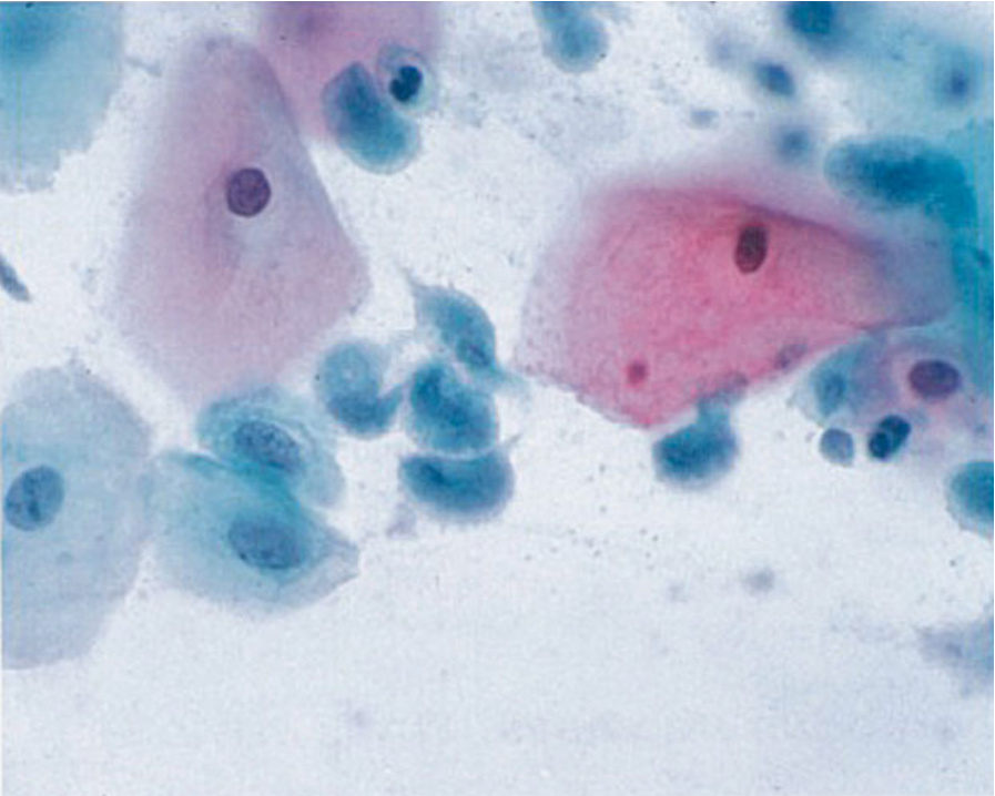 DrCycloPath's tweet image. #PathQuiz 🔬🔬 #CytoPath

A) Candida Species
B) Trichomonas vaginalis
C) Bacterial Vaginosis
D) Actinomyces

#Pathology #Microbiology Clue in caption 🧐