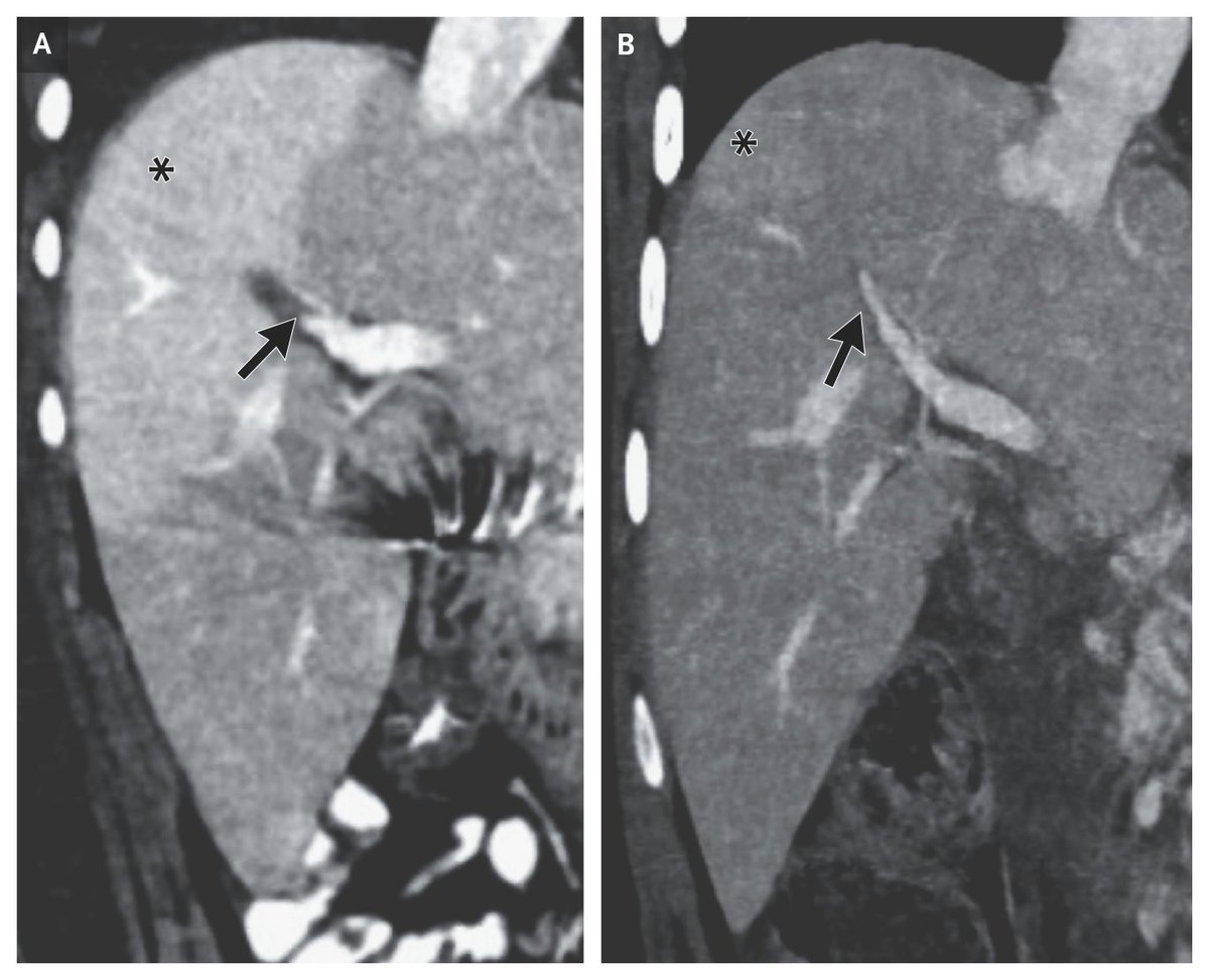 NEJM's tweet image. Images in Clinical Medicine: Hepatic Arterial Buffer Response nejm.org/doi/full/10.10…

#Gastroenterology #Radiology